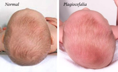 plagiocefalia